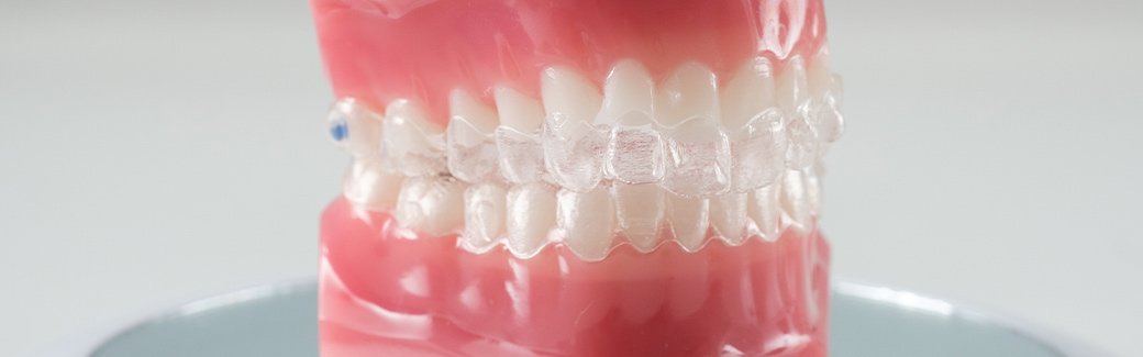 ortodonzia trasparente