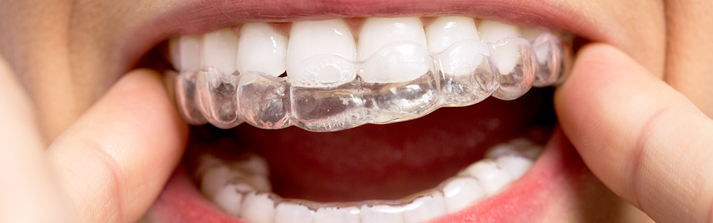 ortodonzia invisibile a Formigine | Studio dentistico Galassini ortodonzia invisibile a Formigine | Studio dentistico Galassini
