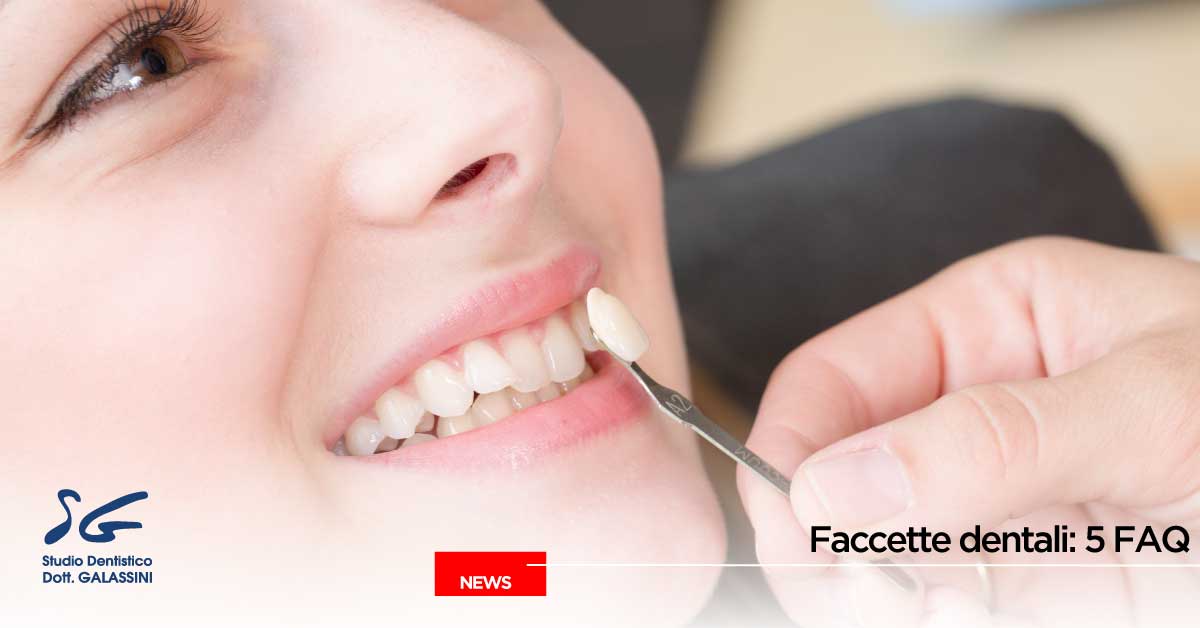 Faccette estetiche dentali: 5 FAQ