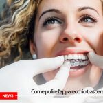 Apparecchio trasparente | Studio Dentistico Galassini | Dentista a Formigine