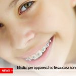 elastici apparecchio | Dentista Galassini