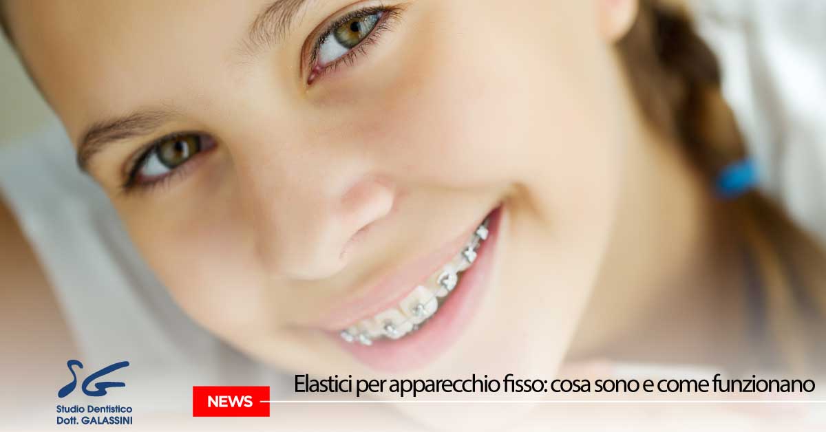 Elastici ortodontici: consigli pratici per l'uso - Dentisti