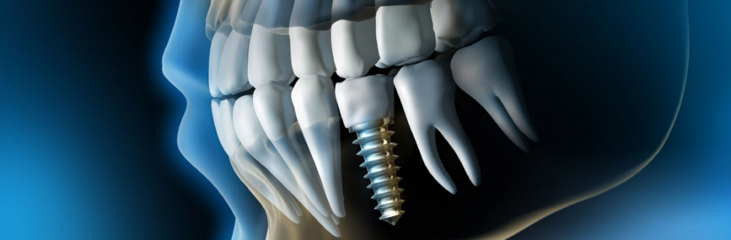 L’impianto dentale: le 5 domande più frequenti