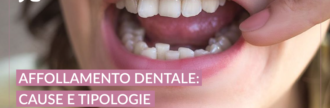 Affollamento dentale: cosa fare