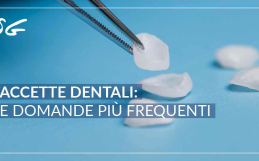 Faccette dentali: le domande più frequenti