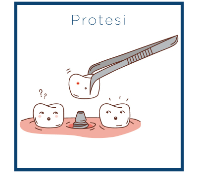 Protesi Protesi